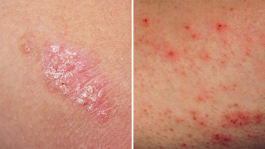 Skin Diseases, Psoriasis ,Eczema