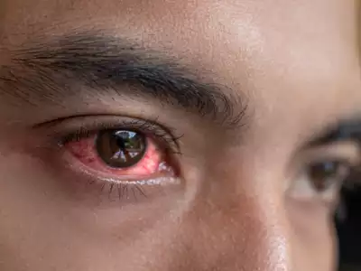 Eye Problems