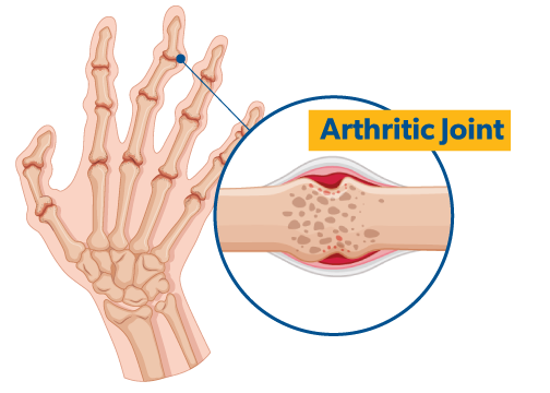 Arthritis