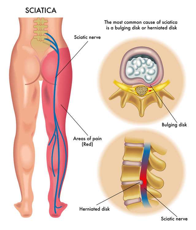 Sciatica nerve pain